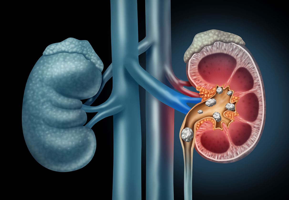 Kidney Conditions